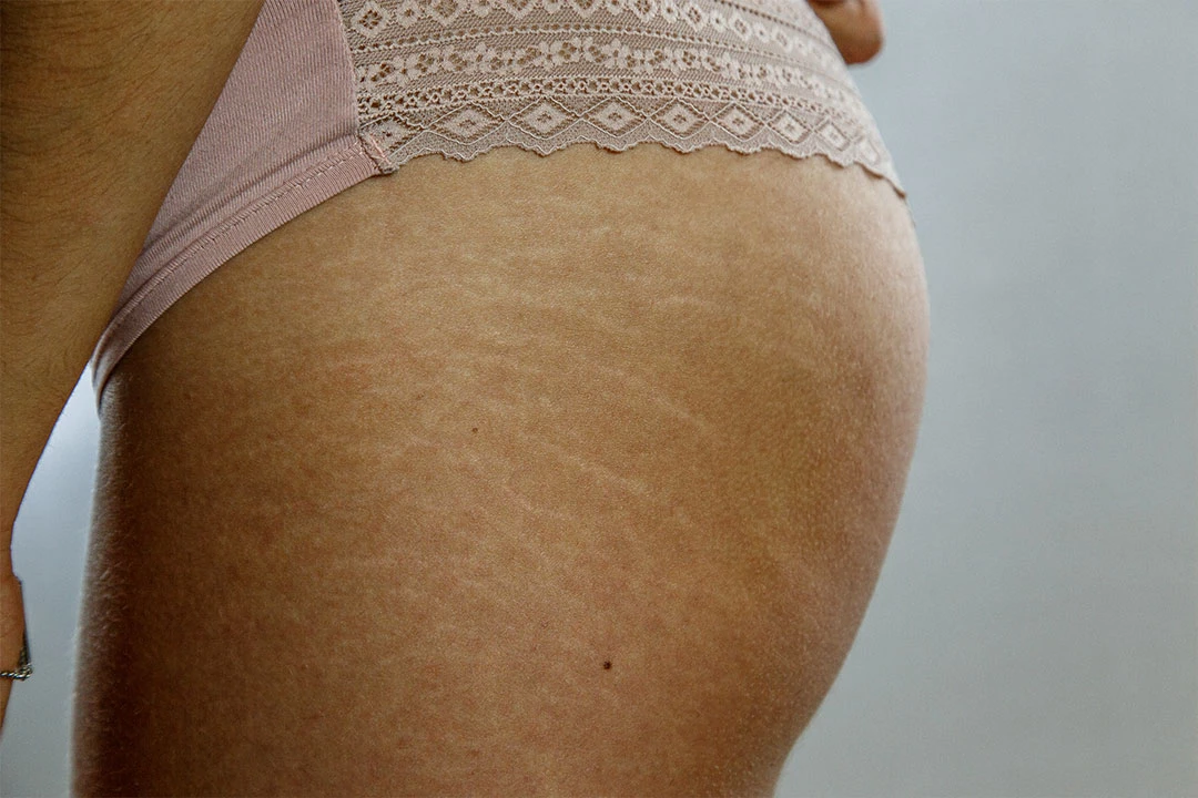 Stretch Marks: Causes, Treatment, Prevention