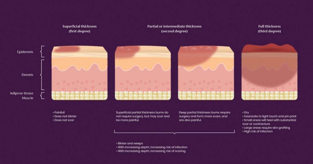 How to care for Sunburn and Burn Scars | Mederma®